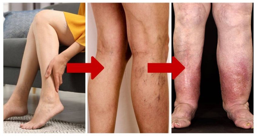 From healthy legs to burning, swollen legs